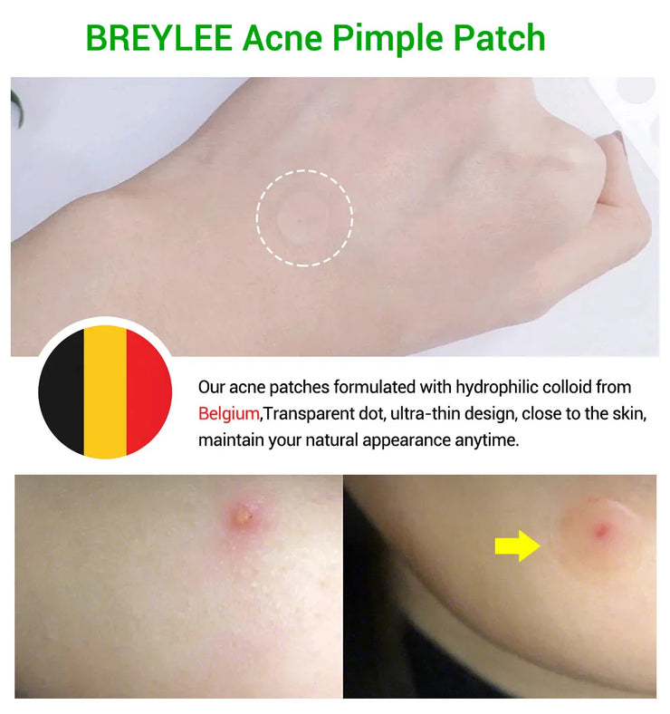 Acne Pimple Removal Patch Stickers